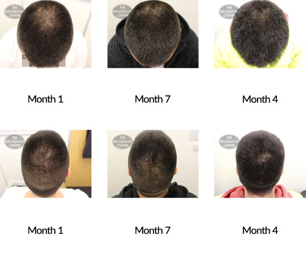 male pattern hair loss the belgravia centre 339281 17 12 2020