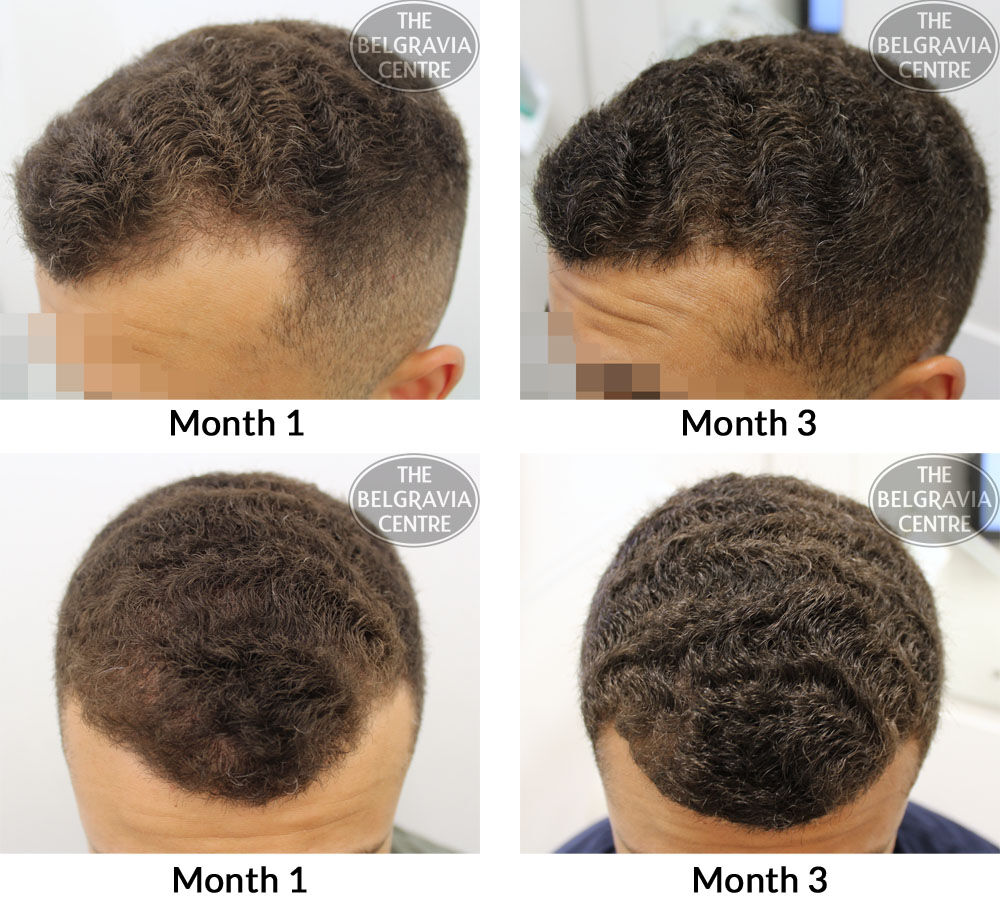 Male Pattern Hair Loss The Belgravia Centre AL 18 08