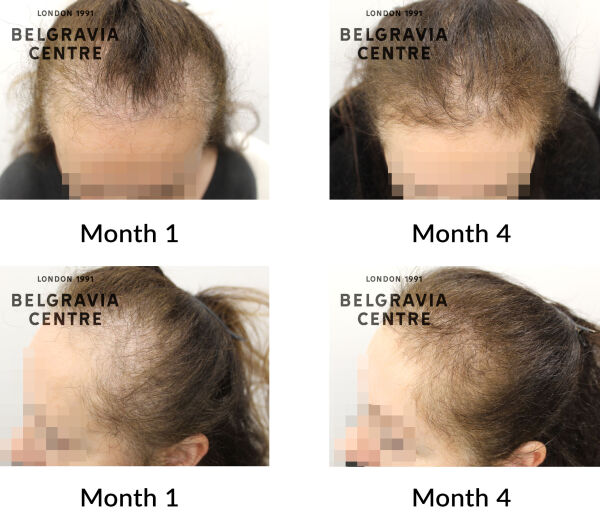 female pattern hair loss the belgravia centre 448072