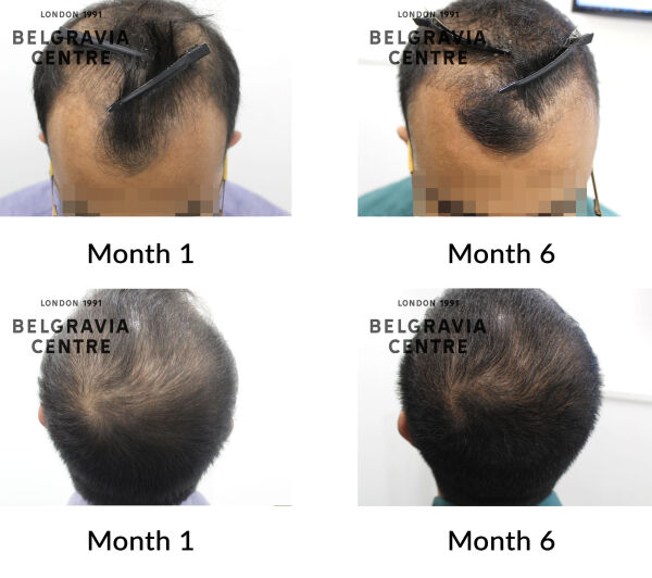male pattern hair loss the belgravia centre 431468