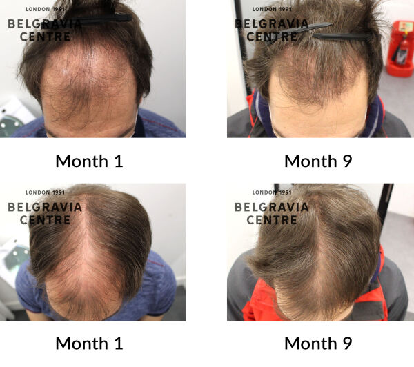 male pattern hair loss the belgravia centre 423344