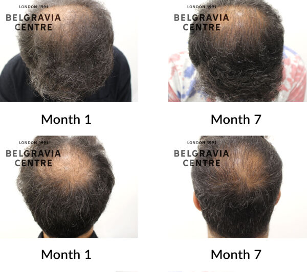 male pattern hair loss the belgravia centre 432225