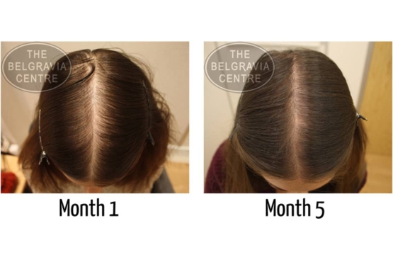 Diffuse Hair Loss Treated at The Belgravia Centre Hair Loss Clinic London