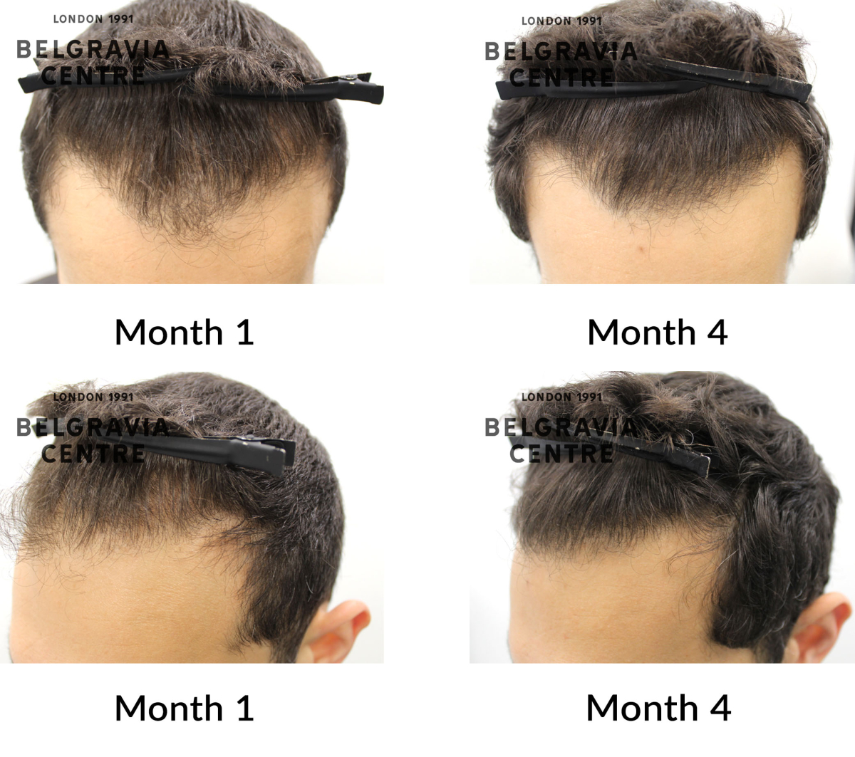 male pattern hair loss the belgravia centre 456539