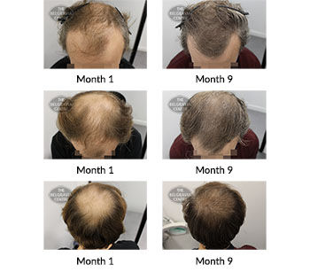 alert male pattern hair loss the belgravia centre 410650 09 07 2021