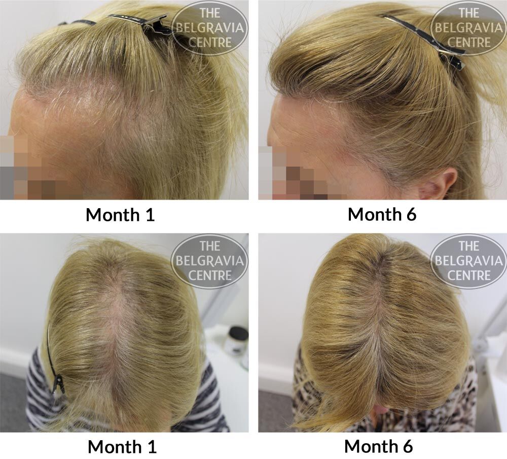Female Pattern Hair Loss Photoscans The Belgravia Centre3