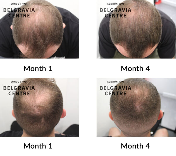 male pattern hair loss the belgravia centre 440542