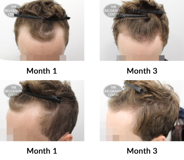 male pattern hair loss the belgravia centre 352602 22 10 2019