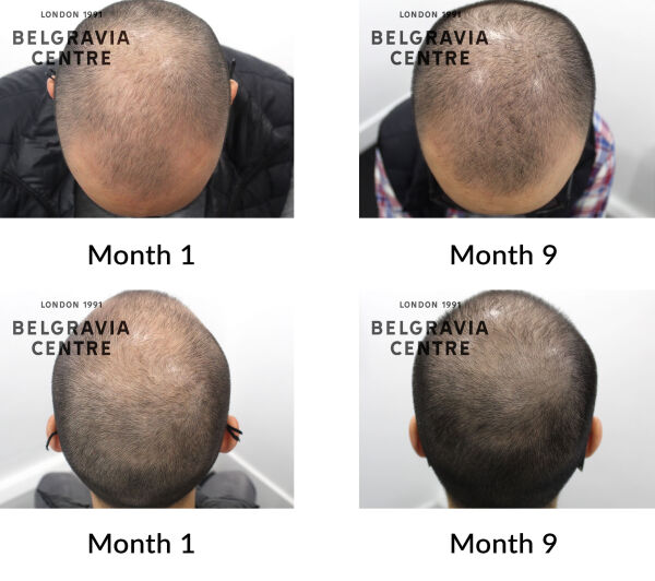 male pattern hair loss the belgravia centre 425116
