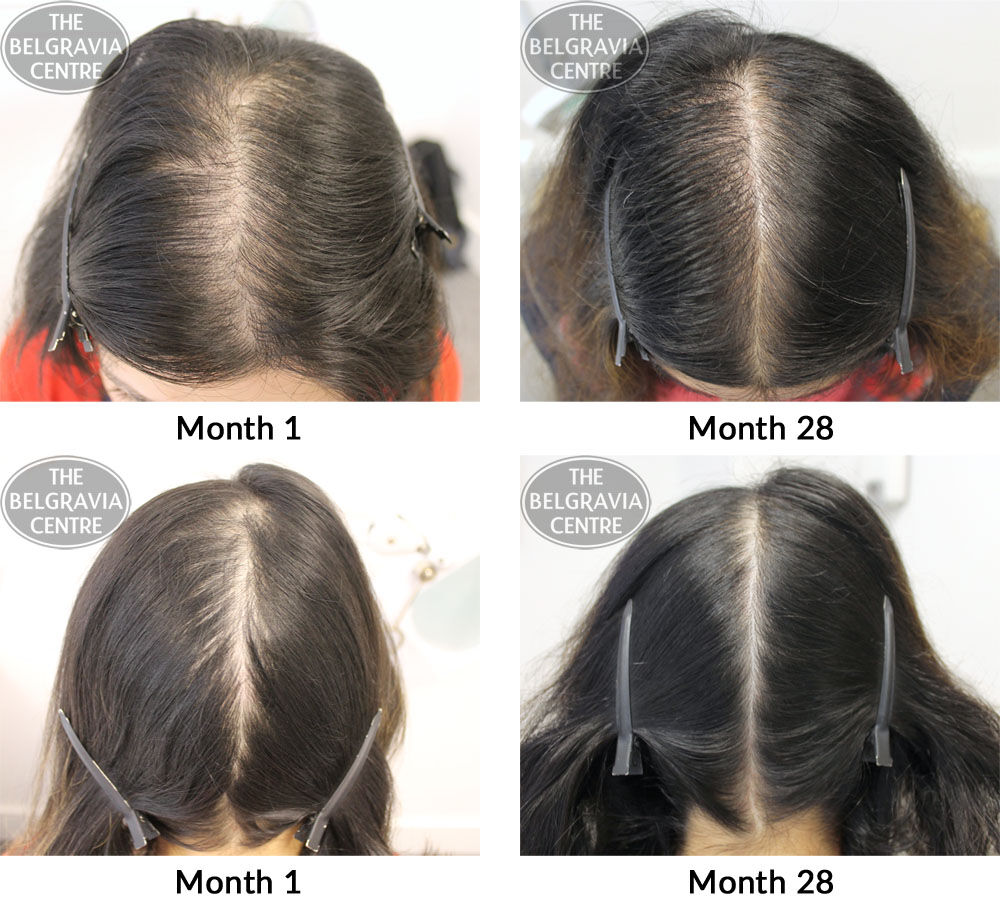 female pattern hair loss the belgravia centre um 16 10 2017