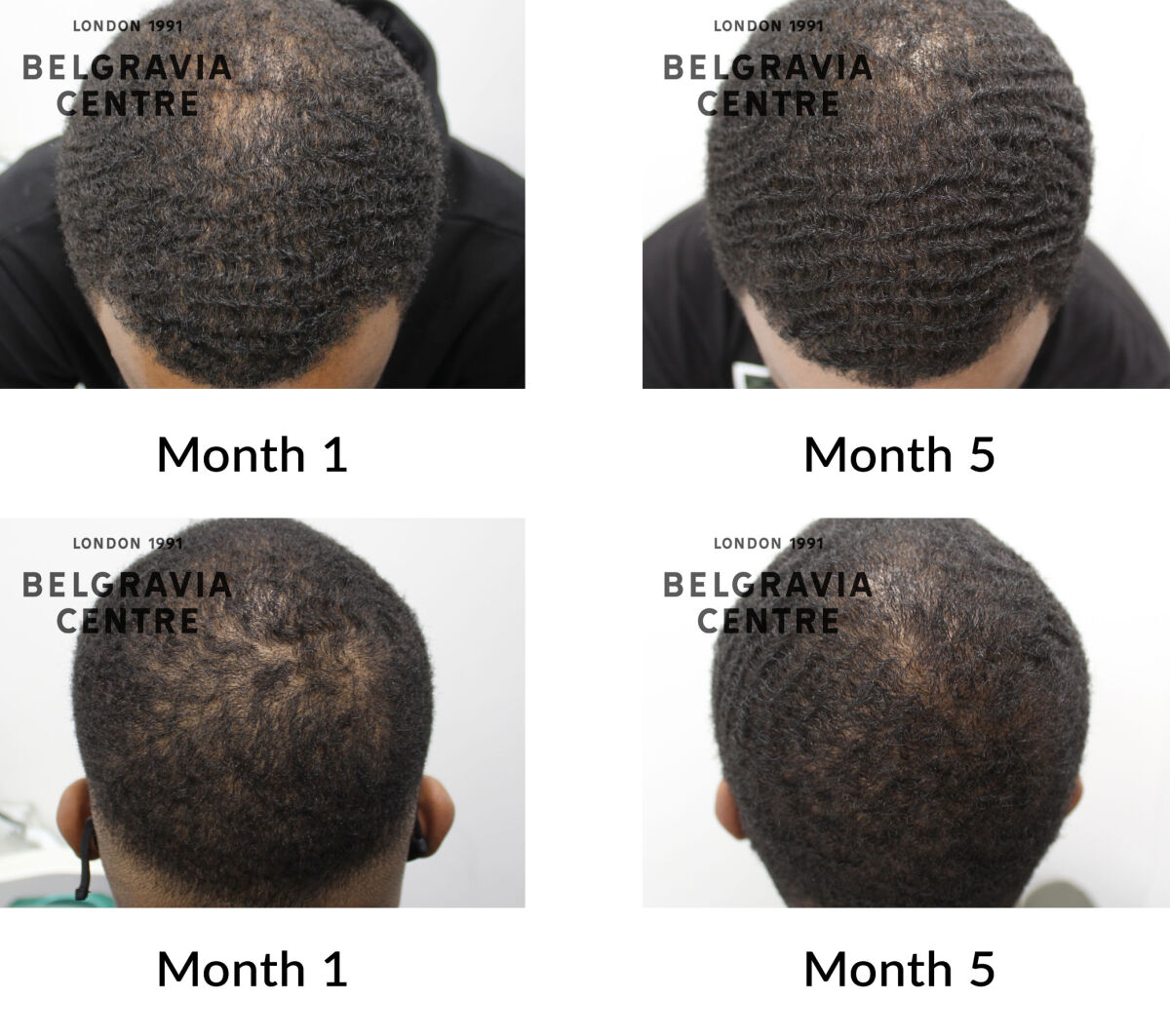 male pattern hair loss the belgravia centre 436027