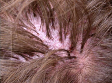 Folliculitis Decalvans Tufted Alopecia