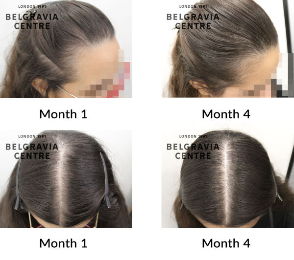 female pattern hair loss the belgravia centre 395158