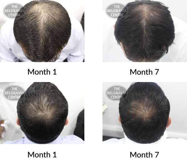 male pattern hair loss the belgravia centre 396885 14 09 2020