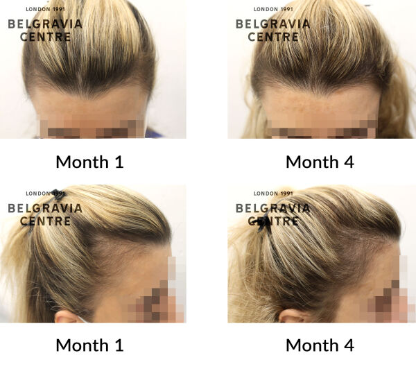 female pattern hair loss the belgravia centre 435635