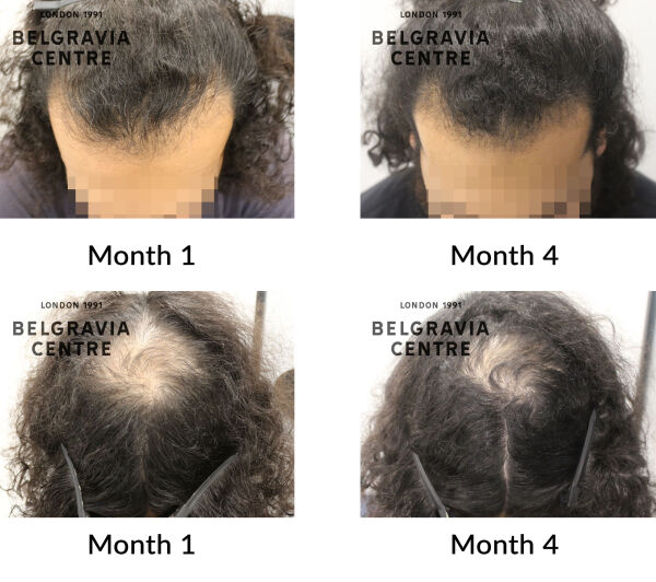 male pattern hair loss the belgravia centre 446837