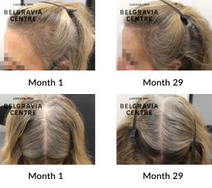 telogen effluvium and female pattern hair loss the belgravia centre 407035