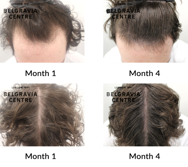 male pattern hair loss the belgravia centre 441882