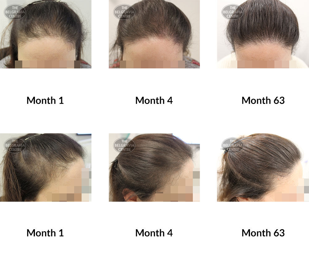 female pattern hair loss and follicular degeneration syndrome the belgravia centre 230340 21 01 2019