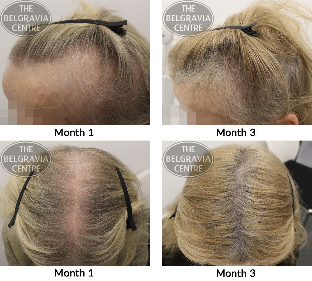 female pattern hair loss and telogen effluvium the belgravia centre CB 15 01 2019