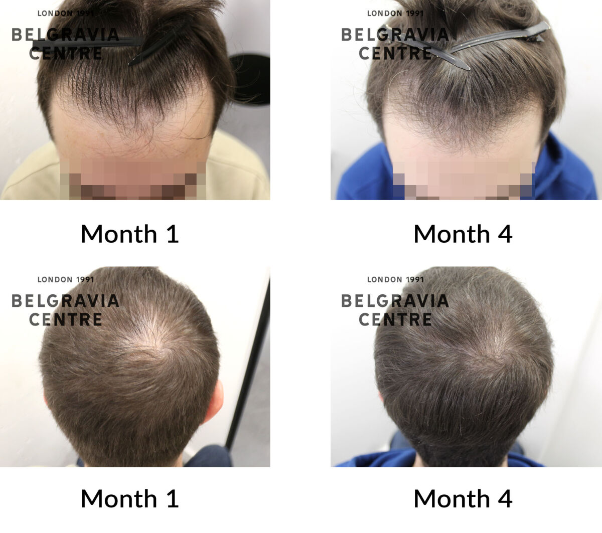 male pattern hair loss the belgravia centre 448180