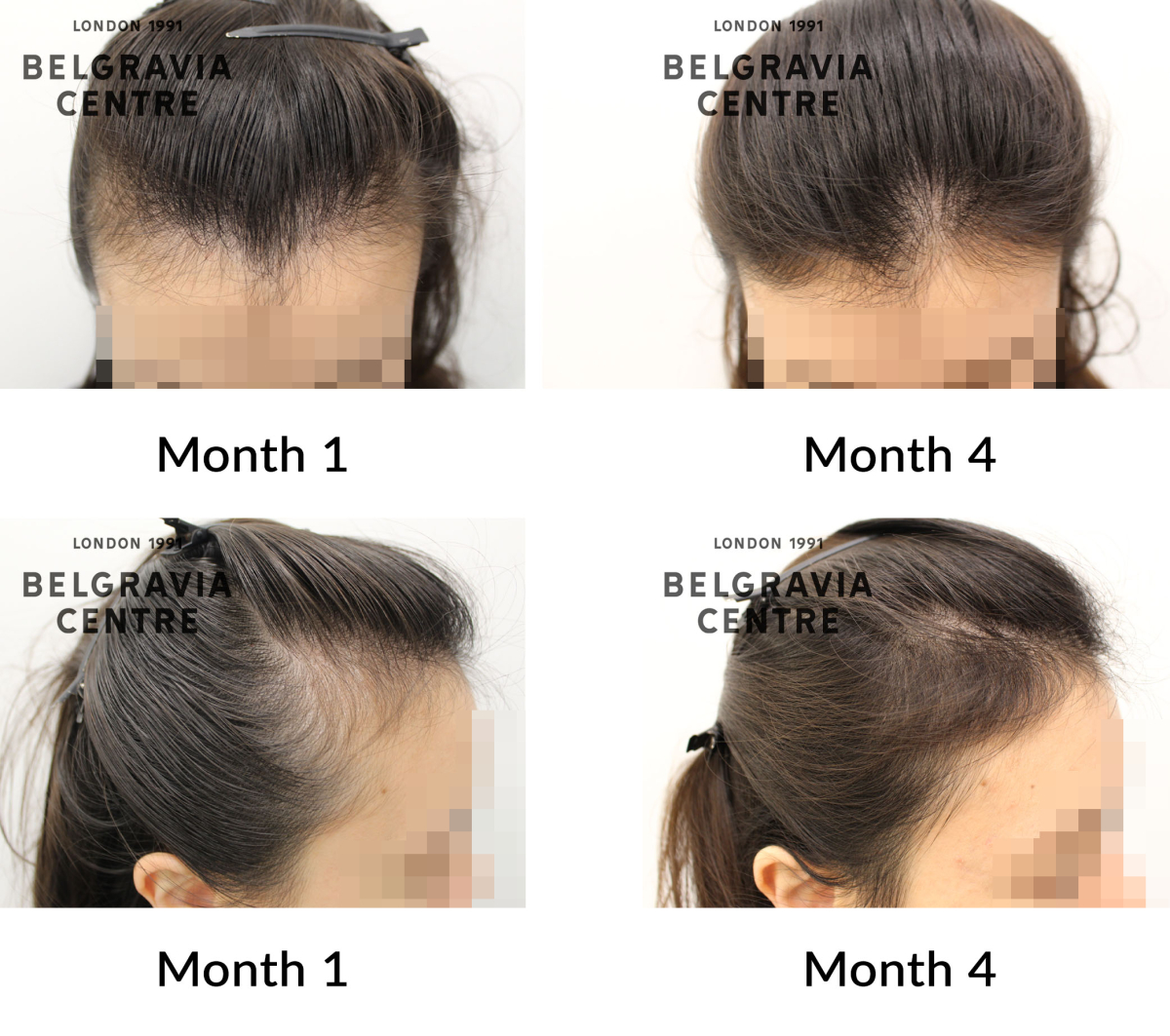female pattern hair loss the belgravia centre 449862