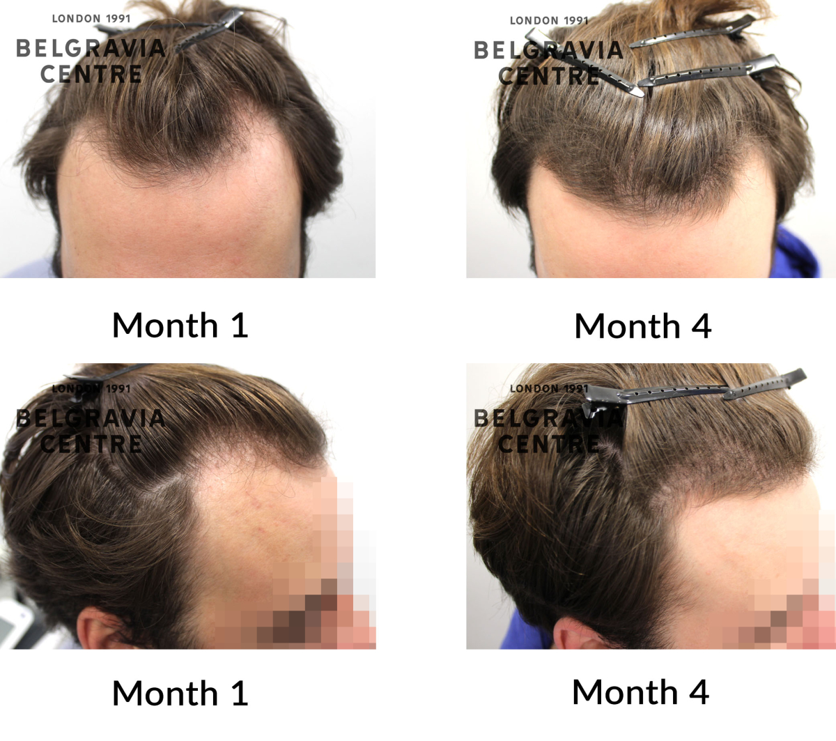 male pattern hair loss the belgravia centre 464611