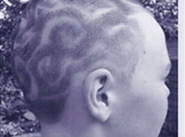 Alopecia Areata Haircut