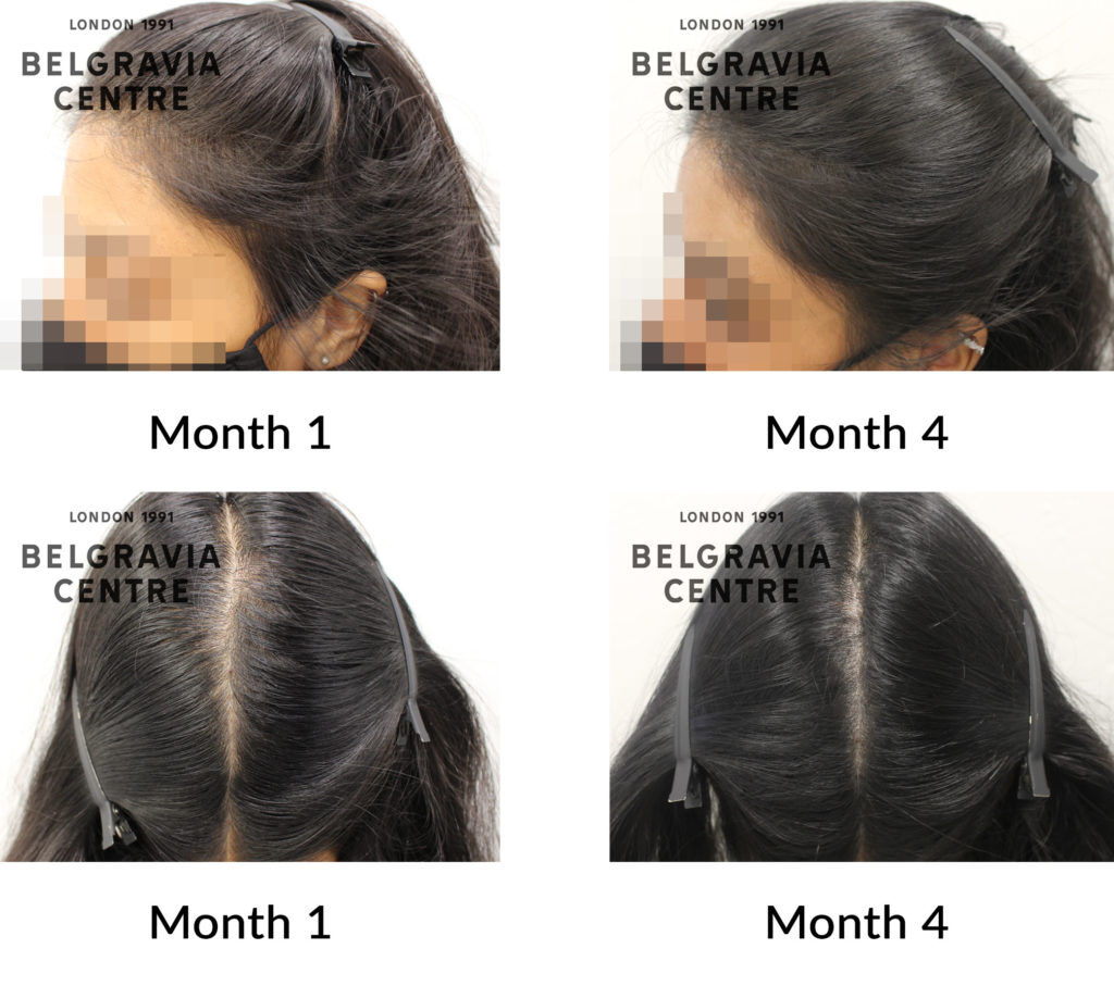 female pattern hair loss the belgravia centre 430187 1024x907