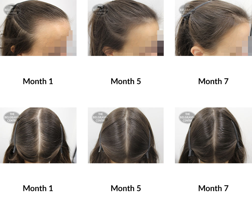 female pattern hair loss and telogen effluvium the belgravia centre 387104 17 02 2020