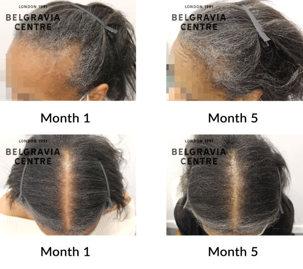 female pattern hair loss the belgravia centre 430670