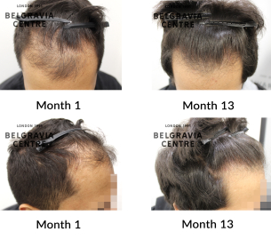 male pattern hair loss the belgravia centre 354609