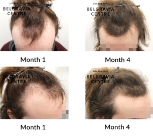 male pattern hair loss the belgravia centre 468349