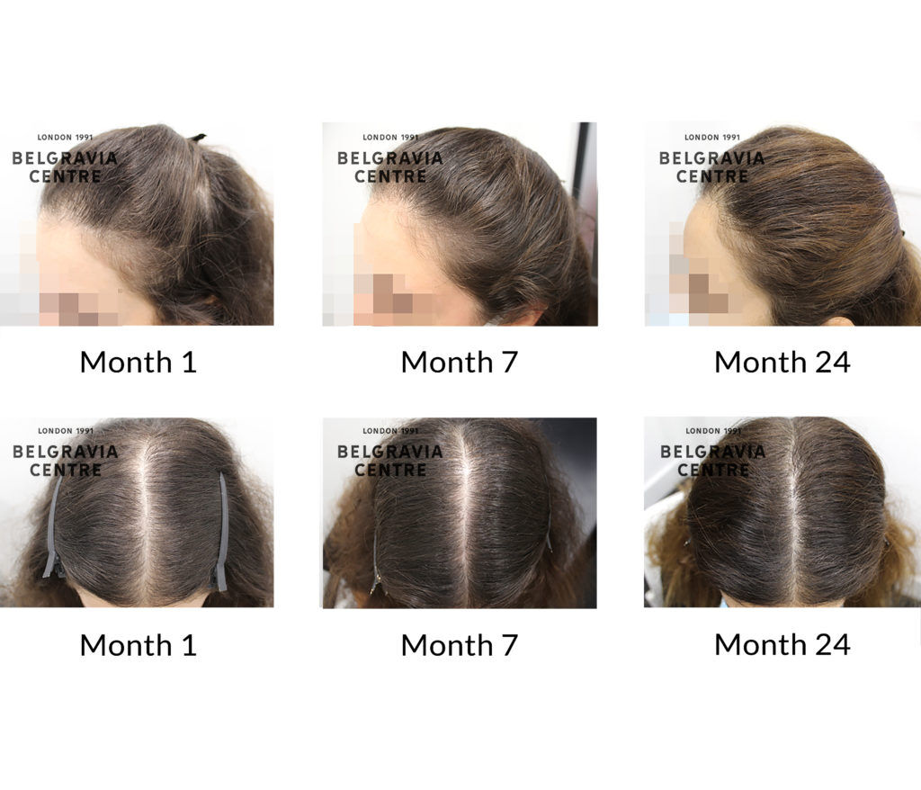 female pattern hair loss the belgravia centre 395879 1024x878