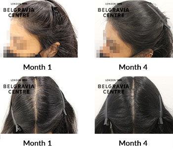 alert female pattern hair loss the belgravia centre 430187