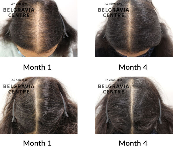 female pattern hair loss the belgravia centre 434961