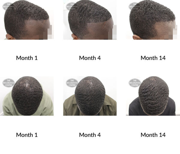 male pattern hair loss the belgravia centre 377069 27 08 2020