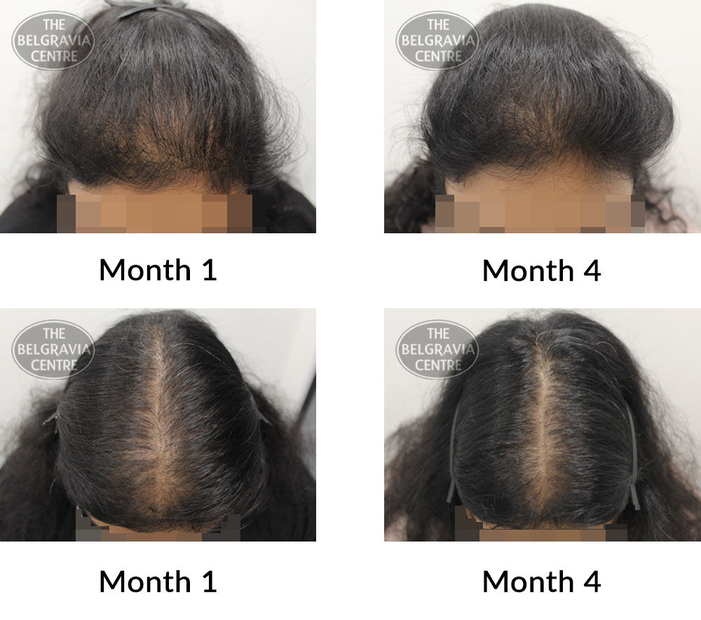 female pattern hair loss the belgravia centre 422798 24 09 2021