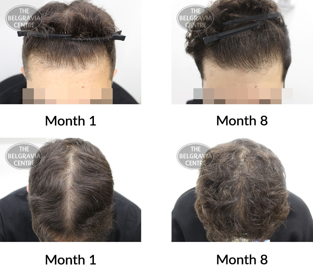 male pattern hair loss the belgravia centre 411321 25 06 2021