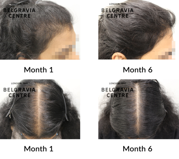 female pattern hair loss the belgravia centre 430303