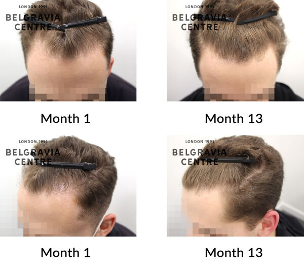 male pattern hair loss the belgravia centre 431765