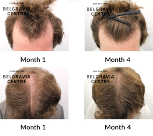male pattern hair loss the belgravia centre 456845