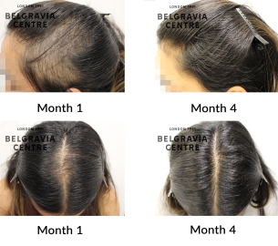 alopecia areata and female pattern hair loss the belgravia centre 463298