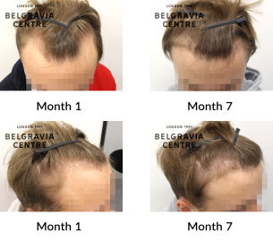 male pattern hair loss the belgravia centre 435366