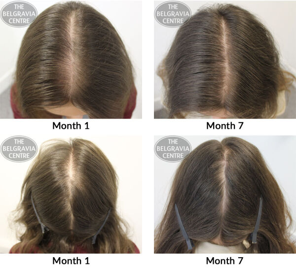 female pattern hair loss the belgravia centre mc 17 05 17