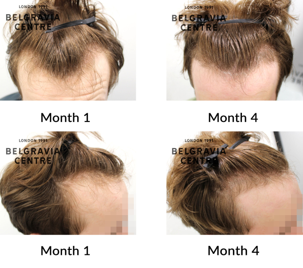 male pattern hair loss the belgaia centre 453032