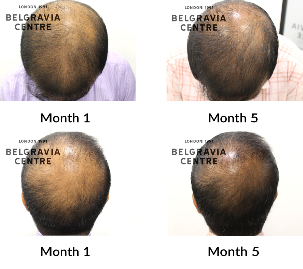 male pattern hair loss the belgravia centre 453608