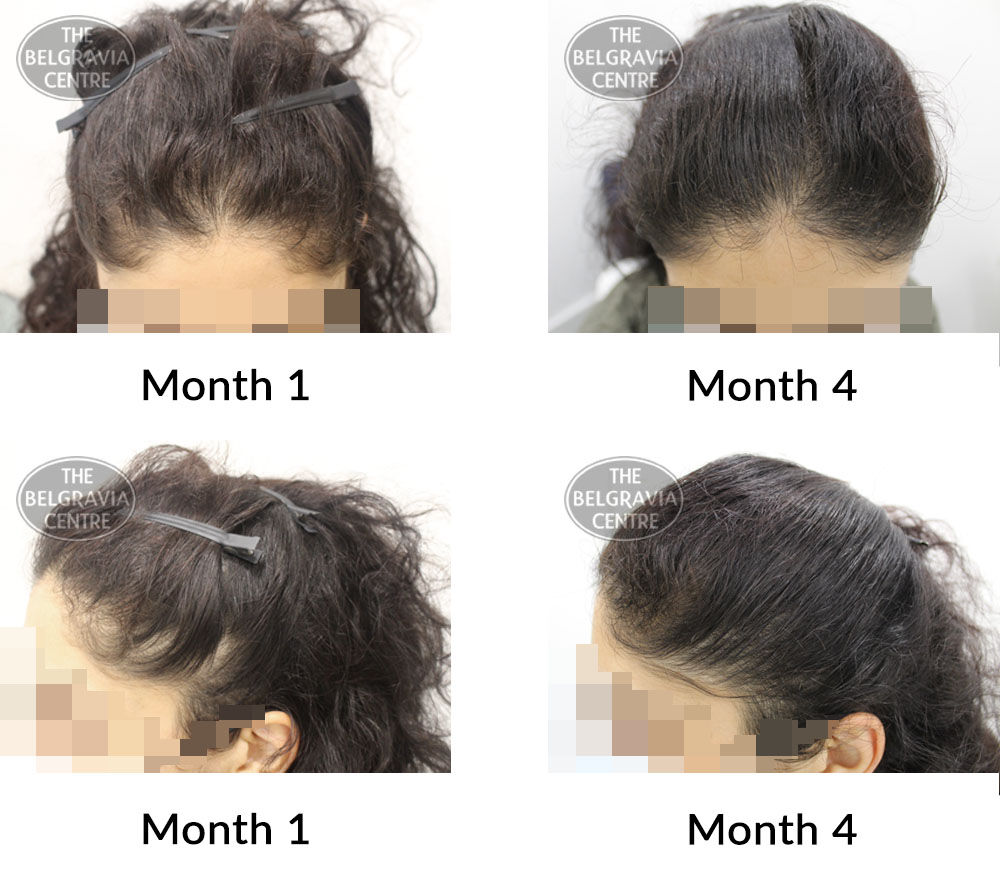 female pattern hair loss the belgravia centre 423763 05 10 2021