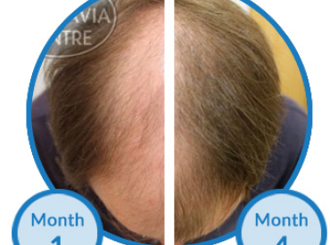 Belgravia Client Tom is Seeing Impressive Regrowth to his Thinning Hair from Treatment