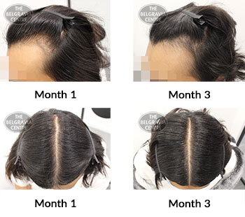 alert male pattern hair loss the belgravia centre 426503 17 11 2021